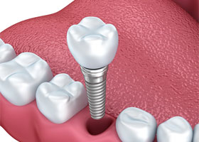 dental implant